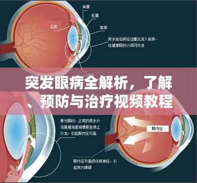 突发眼病全解析，了解、预防与治疗视频教程上线！