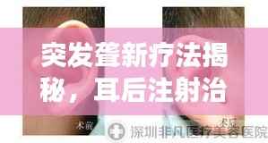 突发聋新疗法揭秘,耳后注射治疗显成效