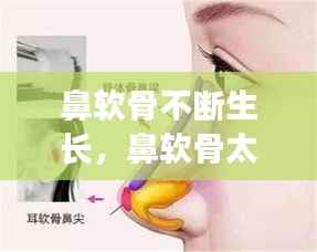 鼻软骨不断生长,鼻软骨太长