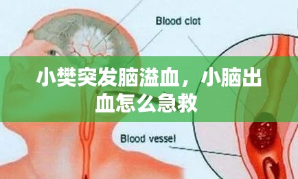 小樊突发脑溢血,小脑出血怎么急救