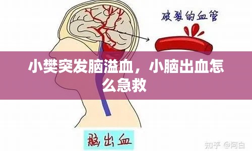 小樊突发脑溢血,小脑出血怎么急救
