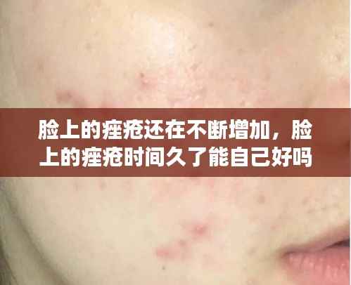 脸上的痤疮还在不断增加，脸上的痤疮时间久了能自己好吗 