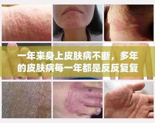 一年来身上皮肤病不断，多年的皮肤病每一年都是反反复复 