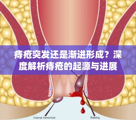 痔疮突发还是渐进形成?深度解析痔疮的起源与进展
