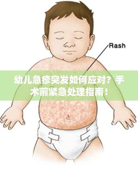 幼儿急疹突发如何应对？手术前紧急处理指南！