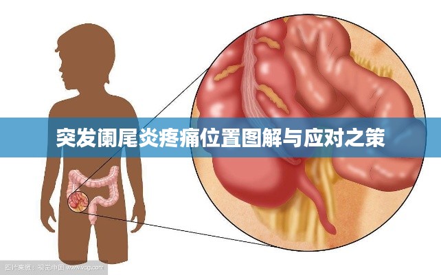 突发阑尾炎疼痛位置图解与应对之策